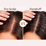 Dry Scalp vs Dandruff: How to Identify and How to Treat Both